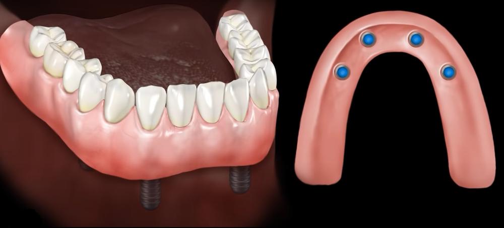 snap on dentures royal palm beach, FL
