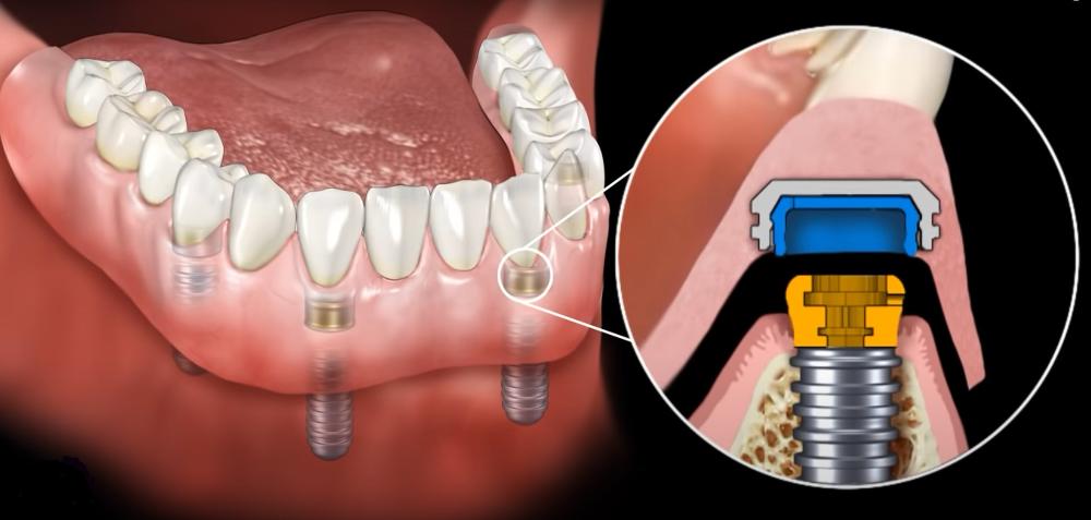 snap-on dentures royal palm beach