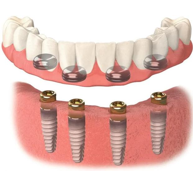implant supported dentures Royal Palm Beach