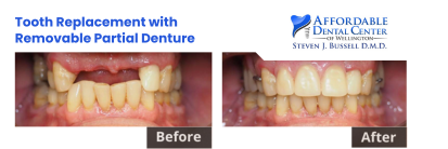partial dentures before and after | tooth replacement royal palm beach