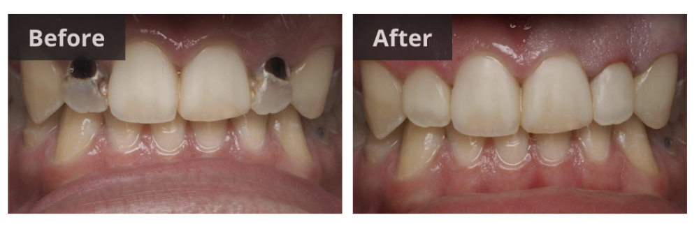 cosmetic bonding before and after royal palm beach