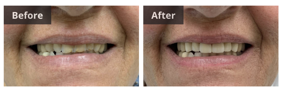 dental veneers before and after royal palm beach