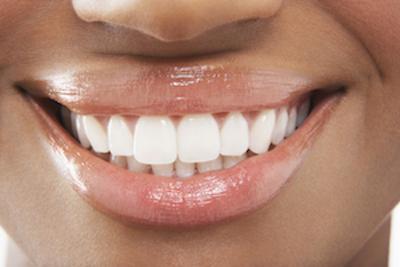 dental filling | close up of a wellington woman's smile 