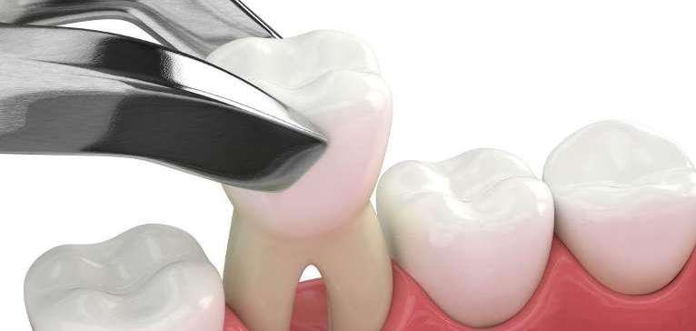tooth extraction for immediate dentures in Royal Palm Beach