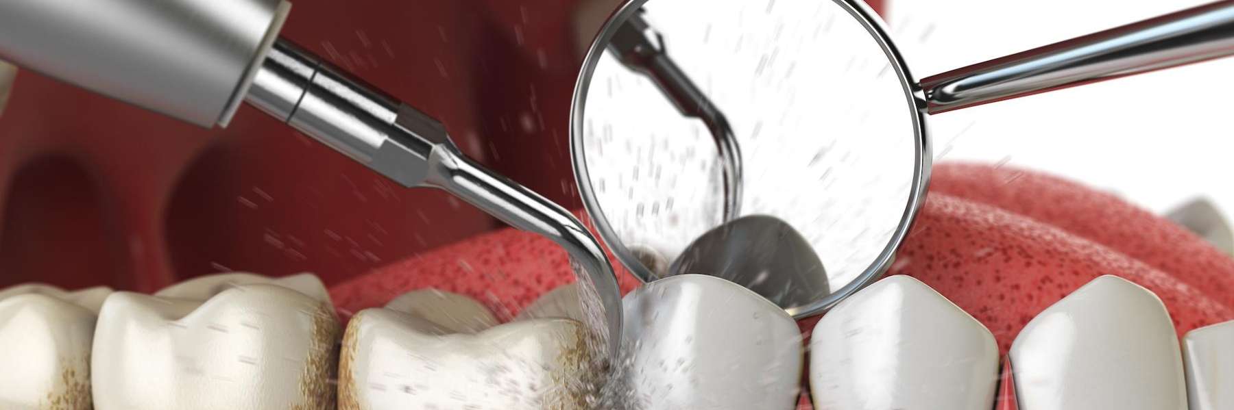 deep cleaning procedure for gum disease in Ryal Palm Beach