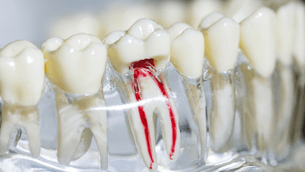 A dental model showing a tooth with exposed root canals highlighted in red.