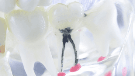 A dental model shows a tooth with root canal filling material inside.