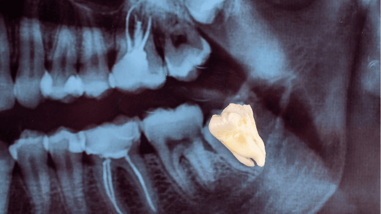 wisdom too x-ray result in Royal Palm Beach