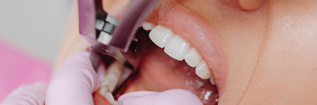 wisdom tooth extraction in Royal Palm Beach