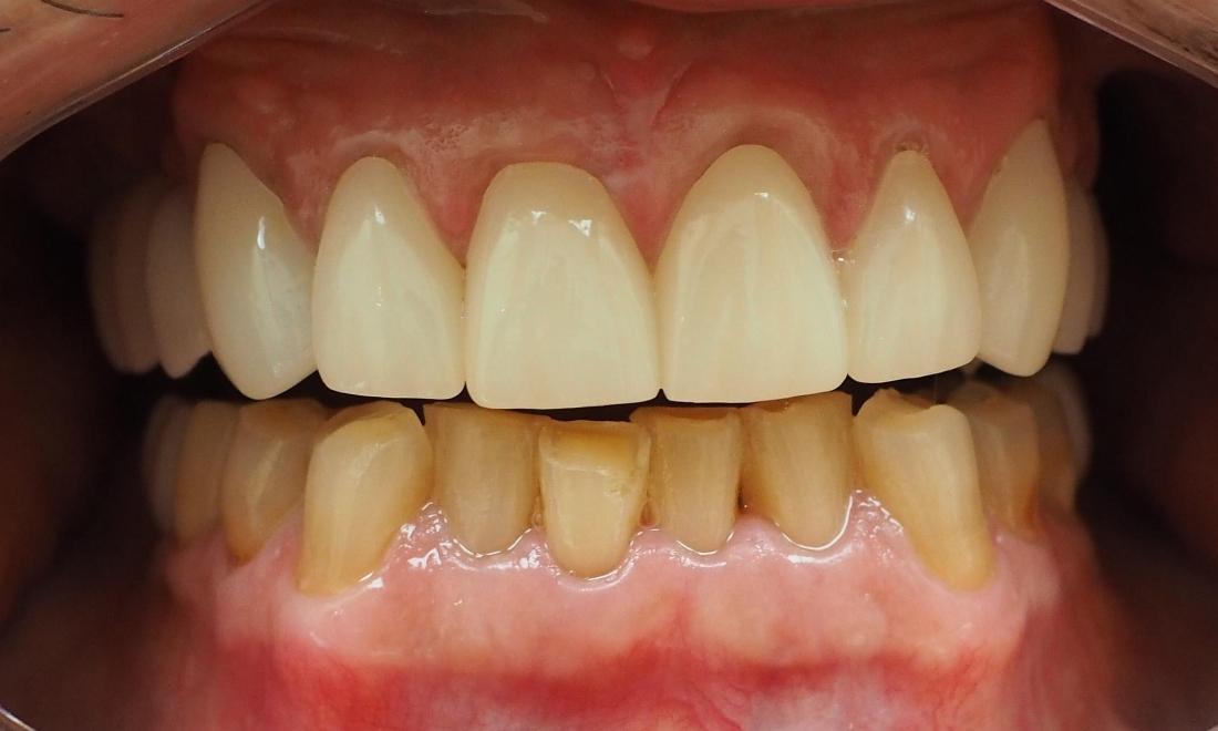 After porcelain dental crowns were used to reconstruct worn front teeth