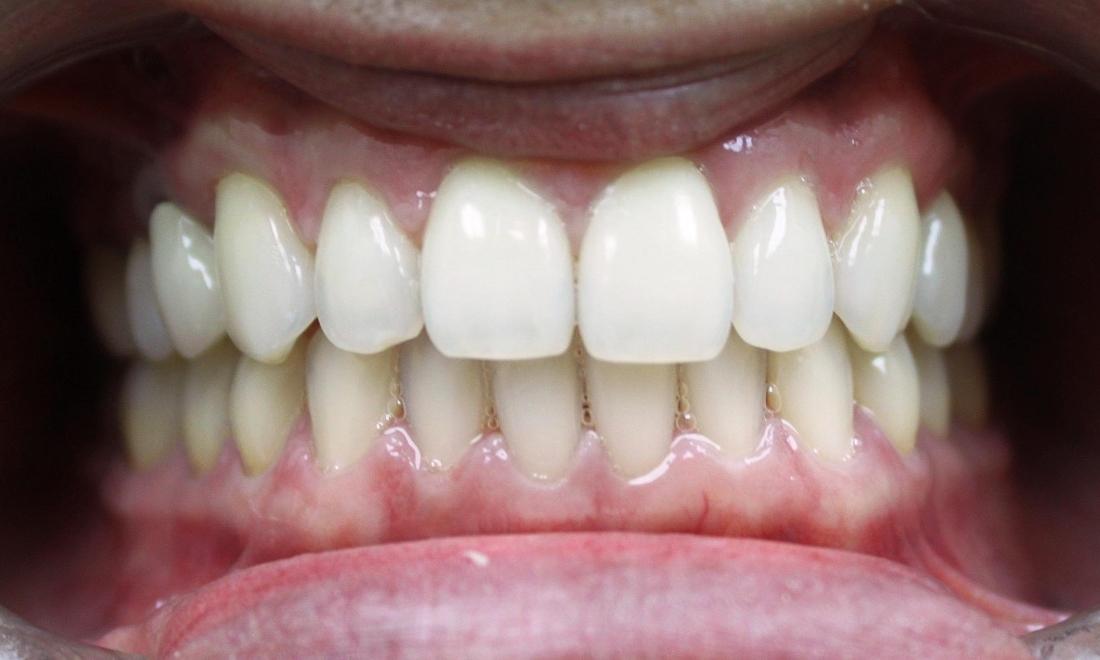 After Photo of invisible braces in royal palm beach