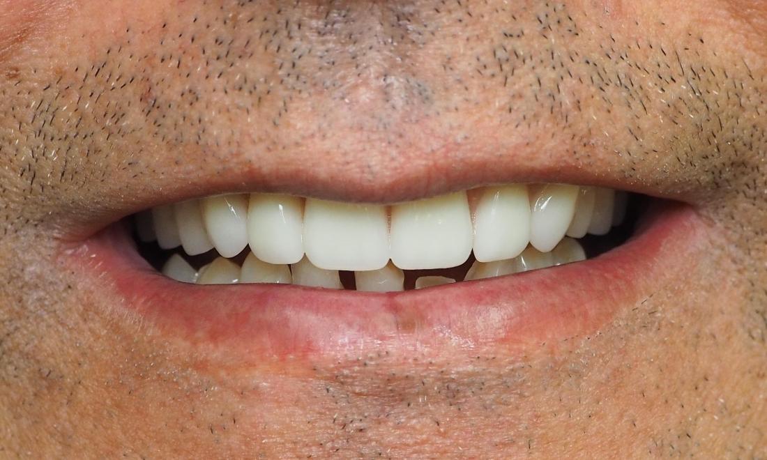 After photo for man with full top dentures 