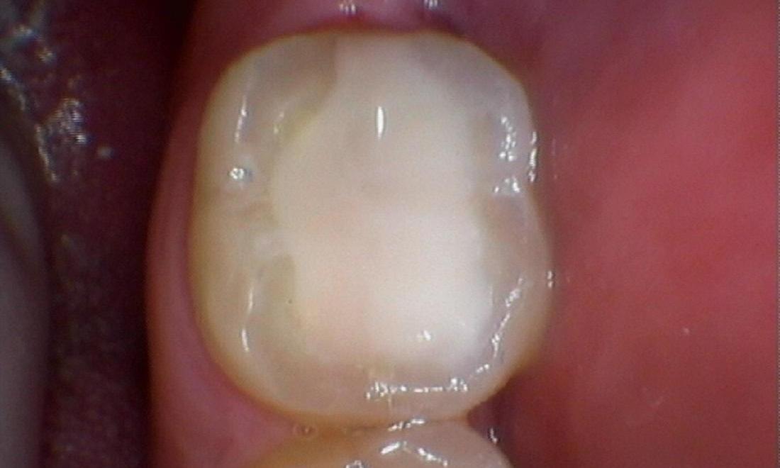 tooth after New composite dental filling