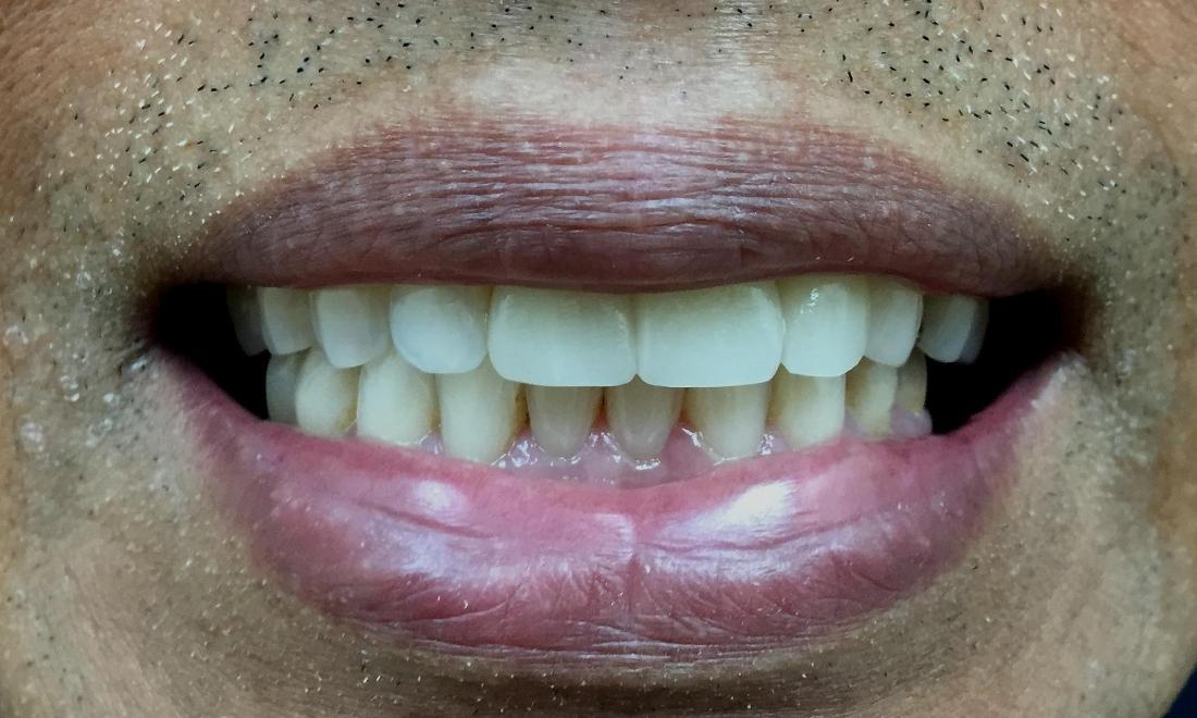 Fixed bridge used to replace fractured front tooth in wellington