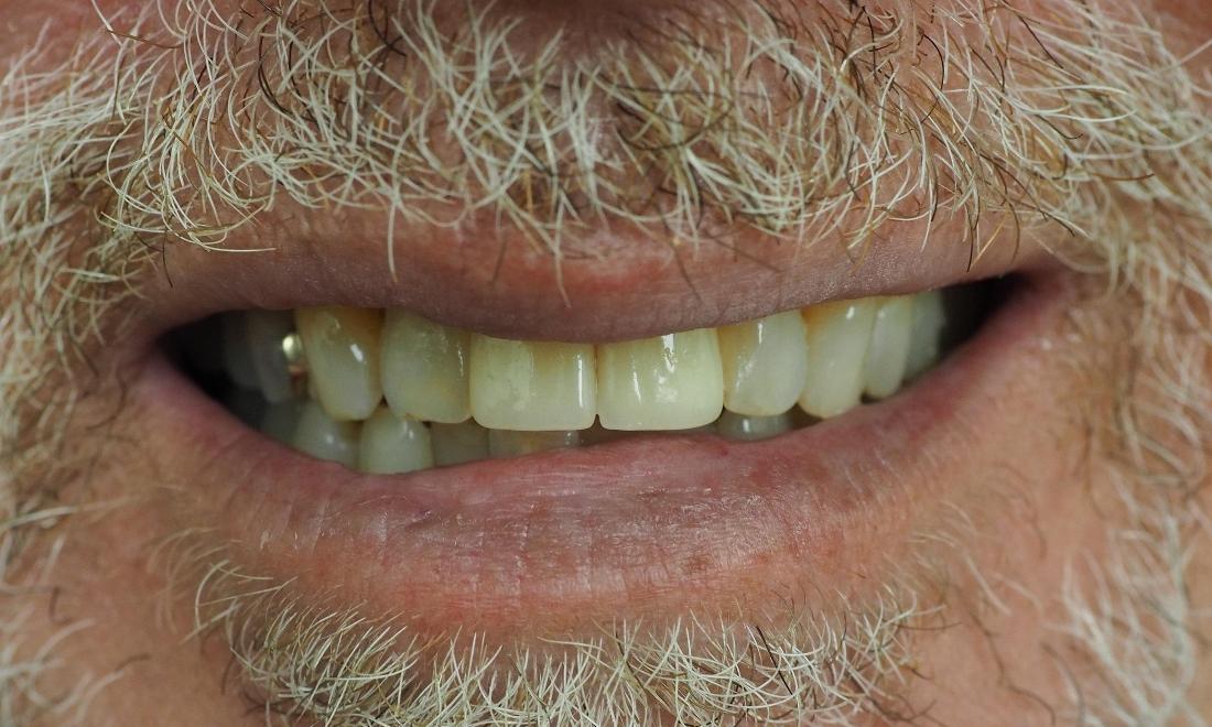 Close up of two front teeth after dental implants