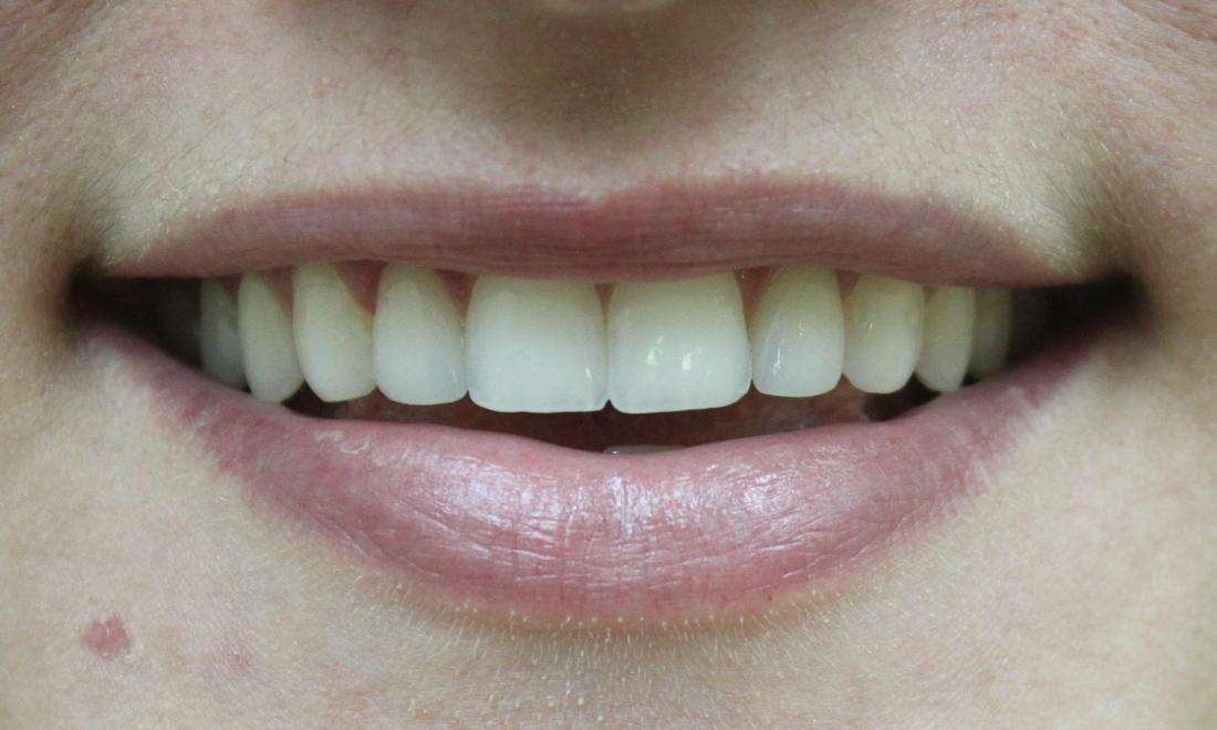 Close up of top teeth after porcelain dental crowns