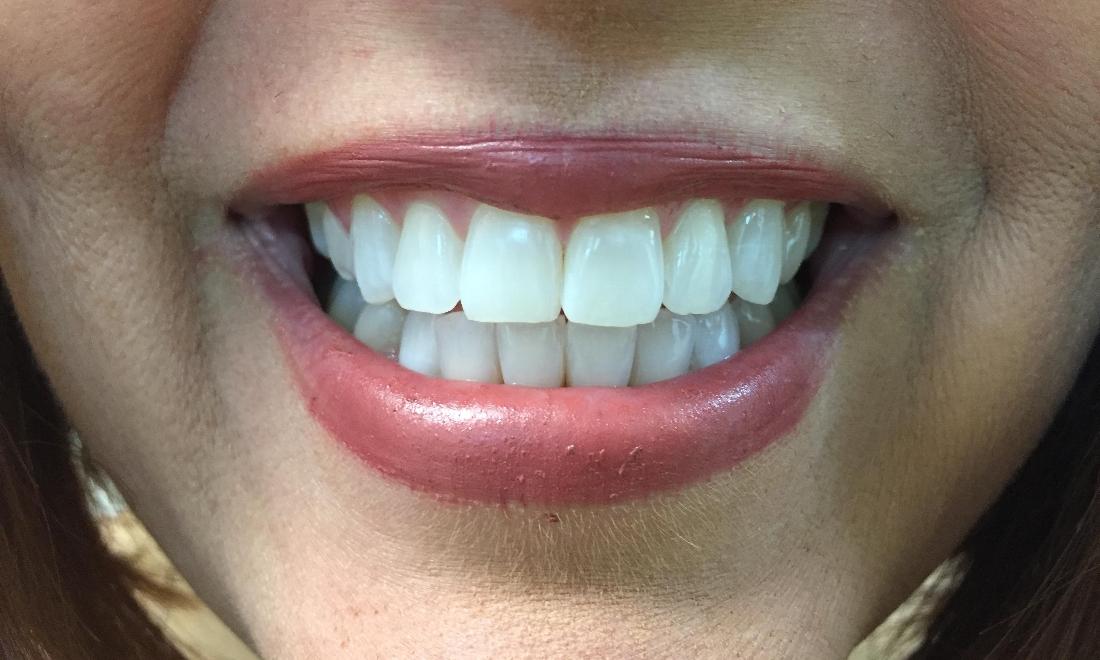 Bright and white teeth after teeth whitening in Royal Palm Beach