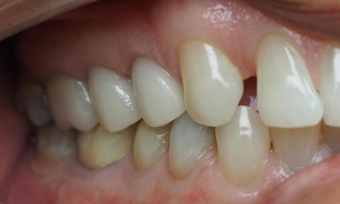 after New porcelain dental crowns 