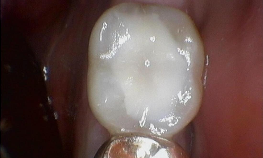tooth after new composite filling