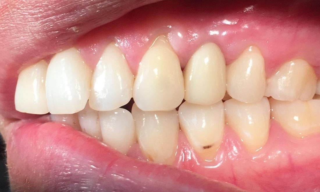 after dental implant replaced missing tooth