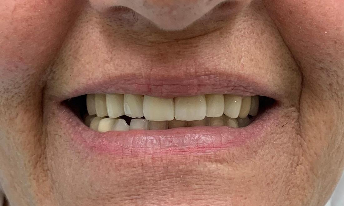  After photo | Porcelain veneers to repair smile in royal palm beach