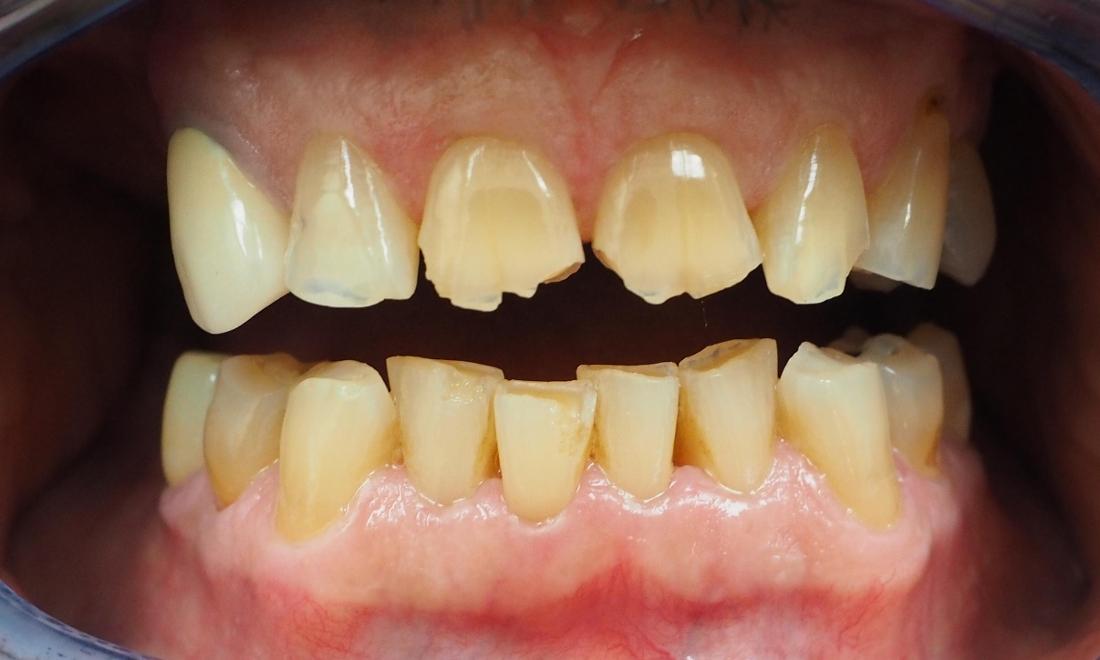 Severely worn and broken front teeth before dental crowns