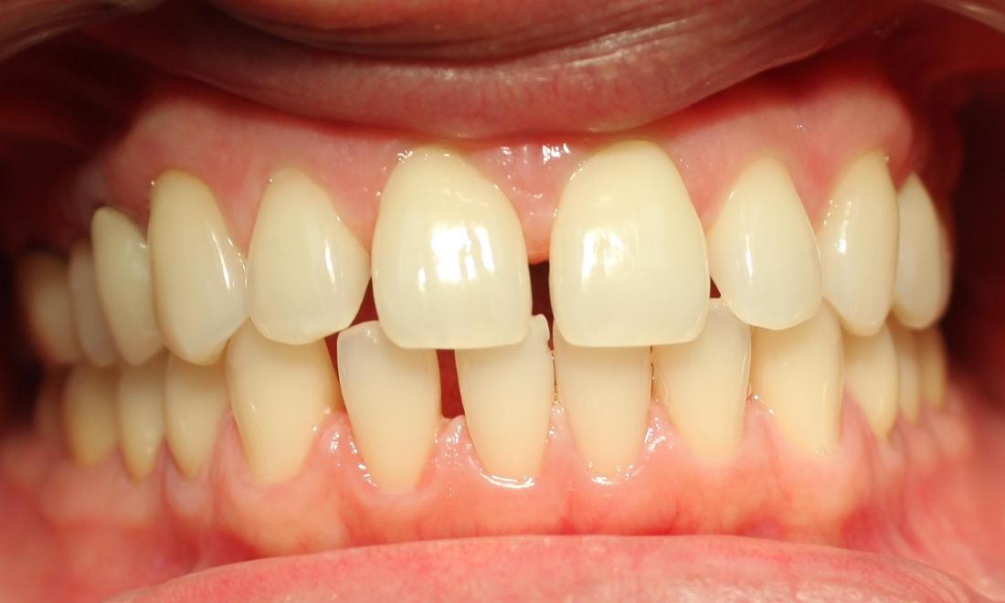 Before Photo of Invisible braces in royal palm beach
