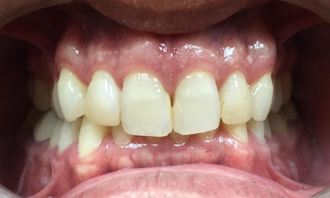 stained and yellowed teeth before | dentist Royal Palm Beach, FL