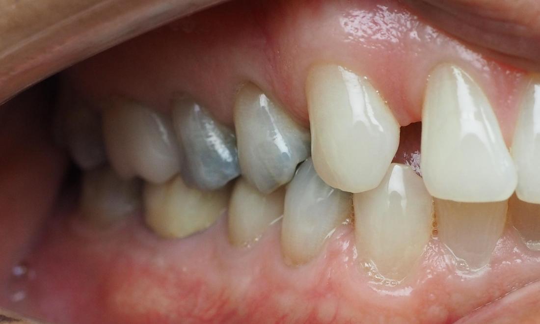 Old, dark fillings in teeth before new dental crowns