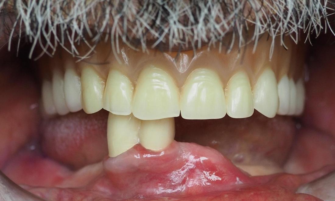 Man missing lower teeth before dentures