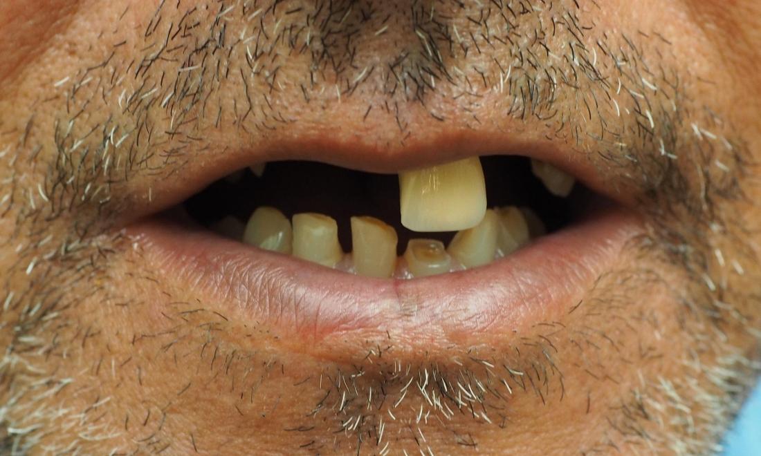 Close up of man missing top front teeth before dentures
