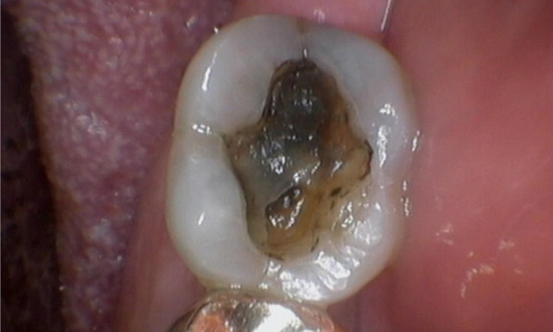 Old silver filling before white filling