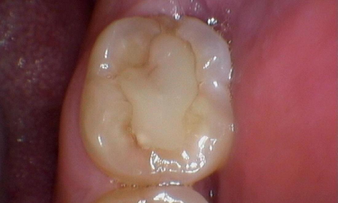 Old, failing dental filling before new dental filling