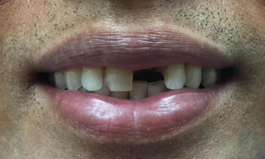 Fractured front tooth before dental bridge in wellington
