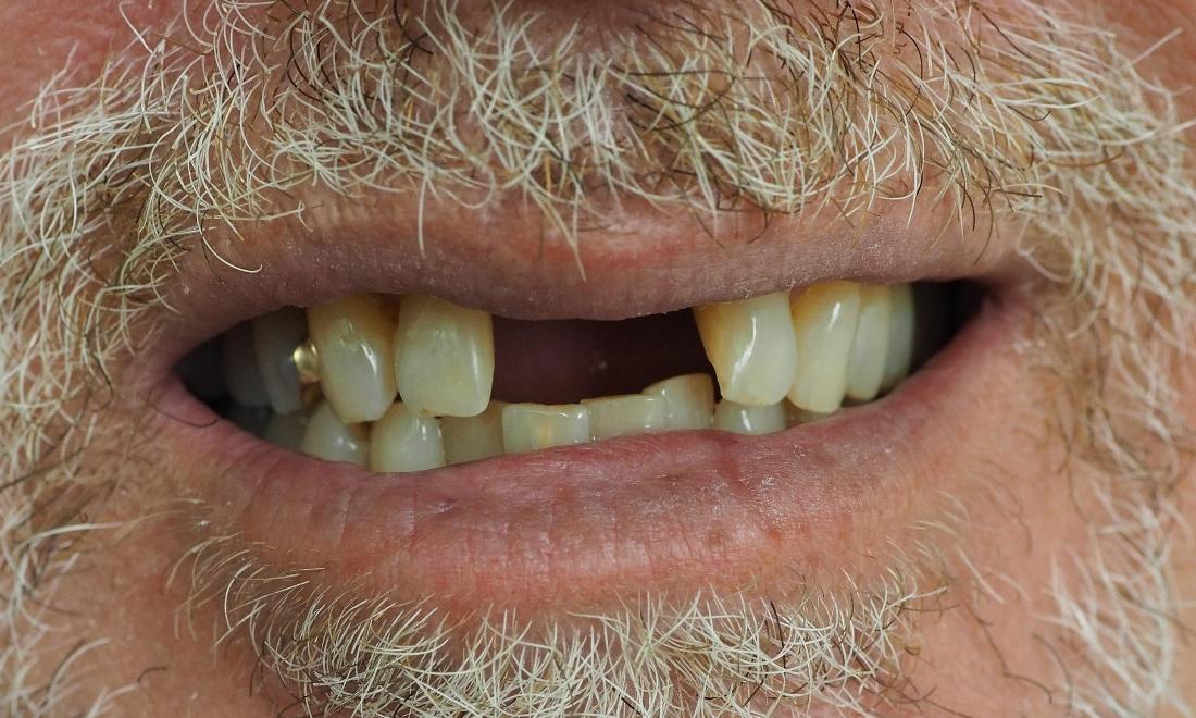 Close up of man missing two front teeth before implants