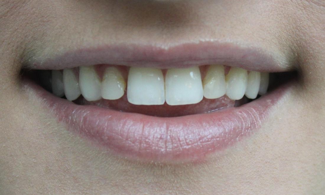 Close up of top teeth with failing dental bonding