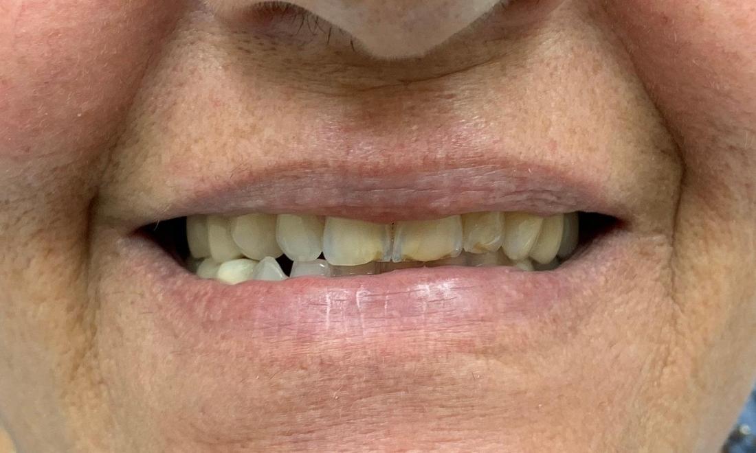Discolored upper teeth before dental veneers in royal palm beach