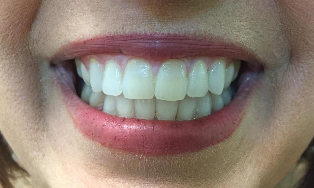 Mildly stained and yellowed teeth before whitening in Royal Palm Beach