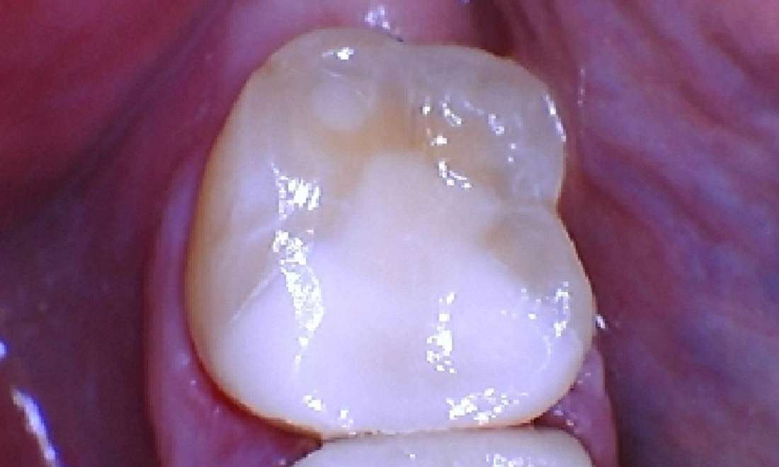 Before & After Photos, Cracked Tooth Repair Gallery