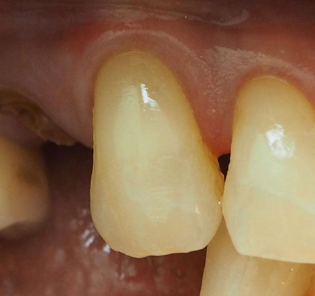 close up of tooth after cavity repair and dental filling