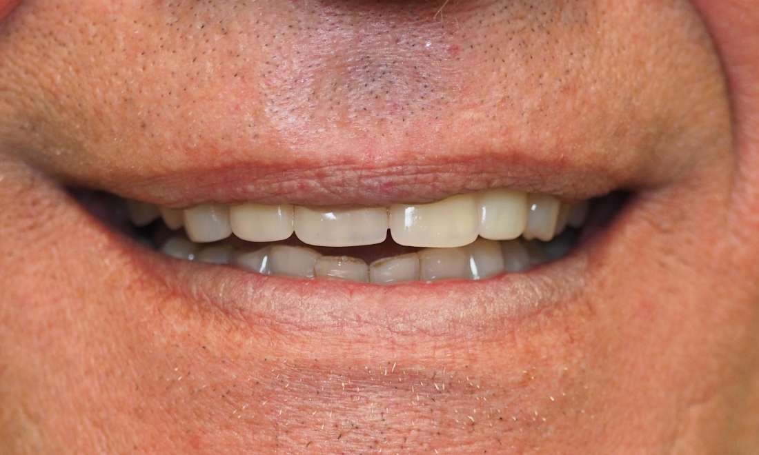 Partial Dentures Before and After | After Dentures