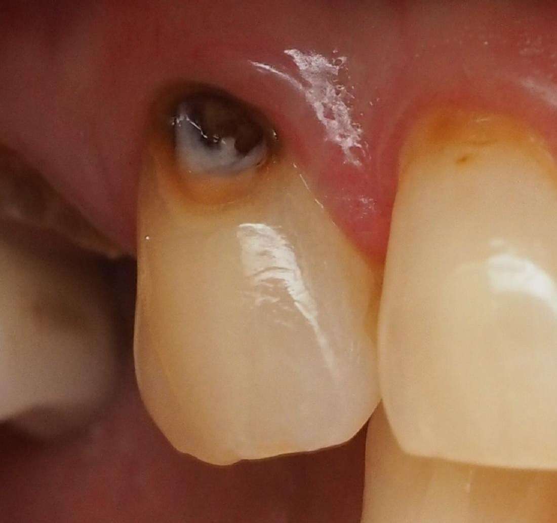 tooth with cavity before treatment