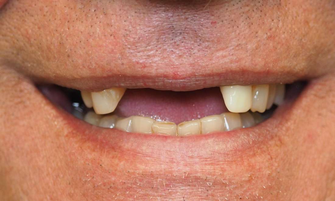 Partial Dentures Before and After | Before Dentures