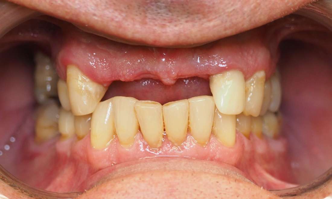 Partial Dentures Before and After | Before Dentures
