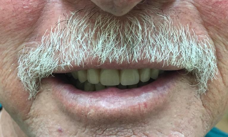 After | Dentures Royal Palm Beach | Dentist