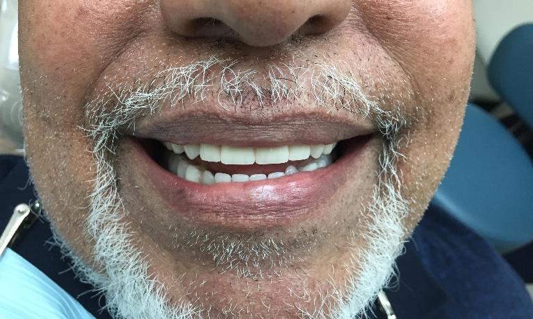 Natural-looking dentures to replace broken front teeth after