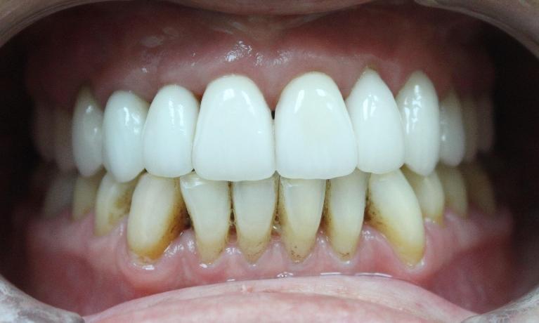 After porcelain dental crowns to transform teeth