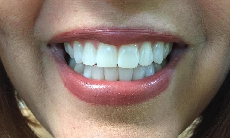 Bright and white teeth after teeth whitening in Royal Palm Beach