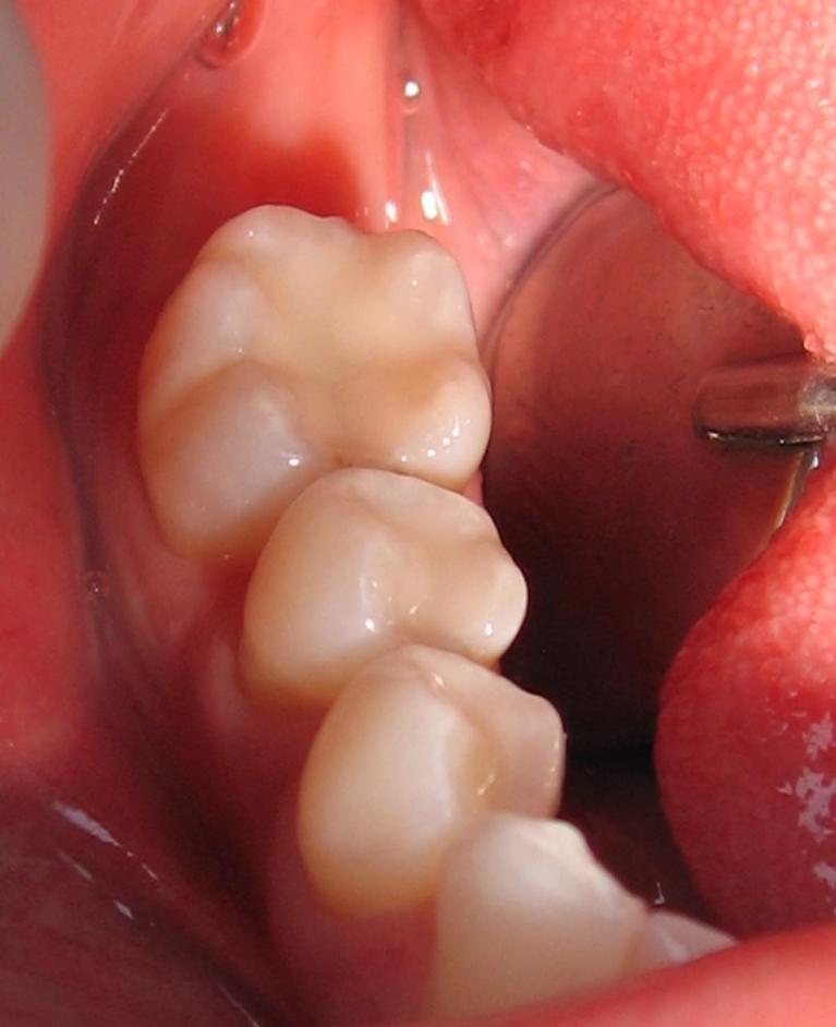 tooth after New resin dental fillings
