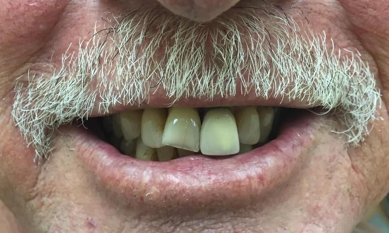 Before Photo | Dentures Royal Palm Beach FL